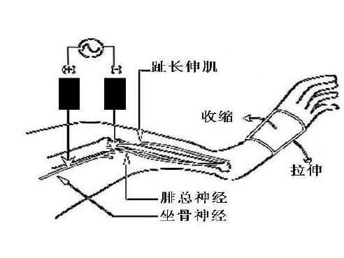 肌肉延遲性酸痛的機制研究進(jìn)展